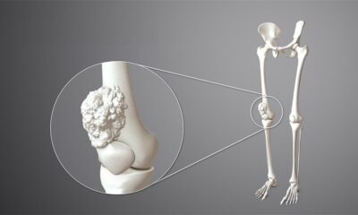Tumore osseo: Sintomi, cause, prevenzioni e diagnosi