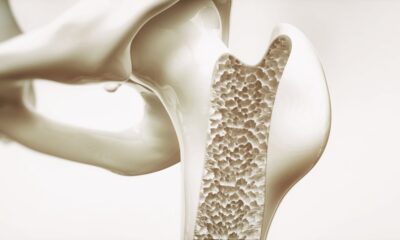 L'Osteosclerosi: Significato, cause e sintomi