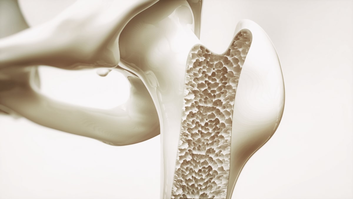 L'Osteosclerosi: Significato, cause e sintomi